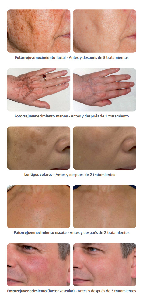 fotorejuvenecimiento-ellipse-beas-clinica