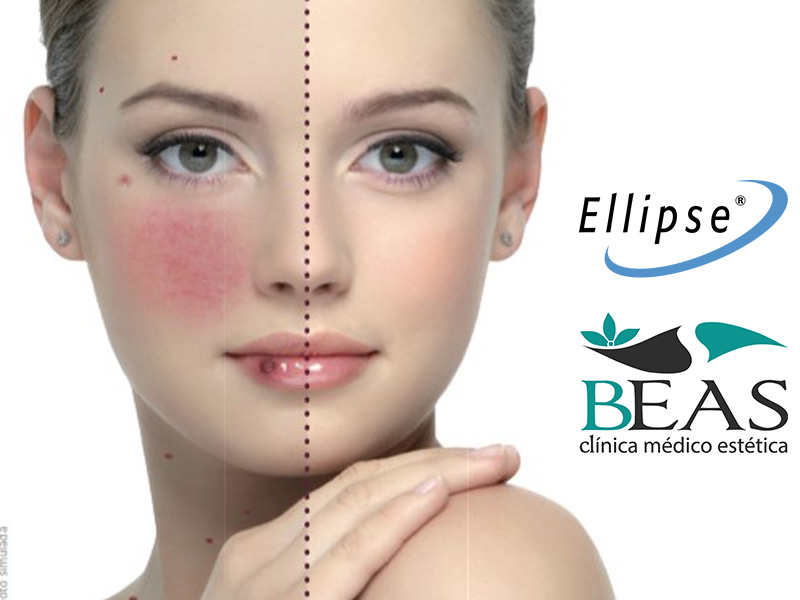 Rojeces en la cara. Tratamiento Ellipse. Clinica Beas